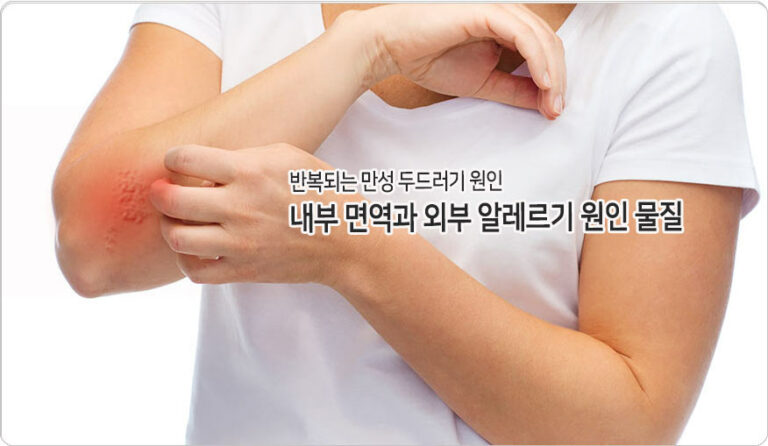 [한방 칼럼] 두드러기의 올바른 이해와 관리 방법